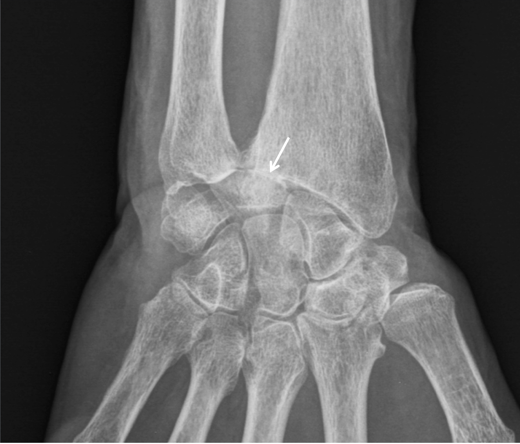 Arthrose du Clinique Ostéo Articulaire des Cèdres Grenoble Arthrose du Clinique Ostéo Articulaire des Cèdres Grenoble